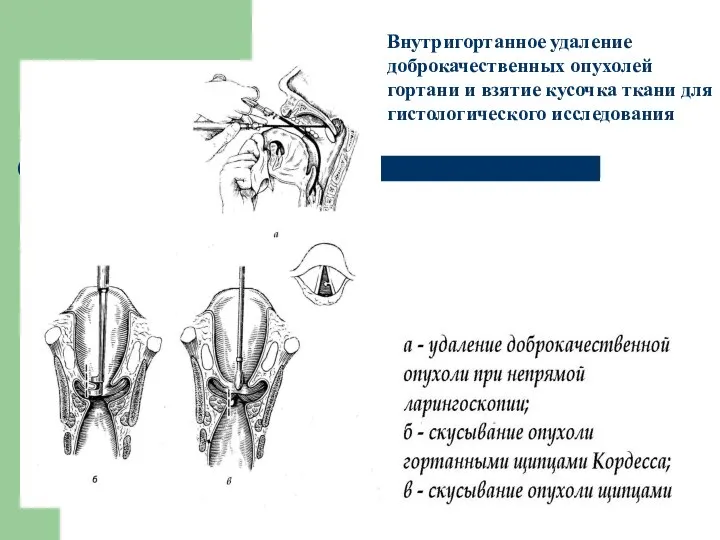 Внутригортанное удаление доброкачественных опухолей гортани и взятие кусочка ткани для гистологического исследования