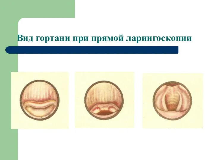 Вид гортани при прямой ларингоскопии