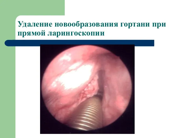 Удаление новообразования гортани при прямой ларингоскопии