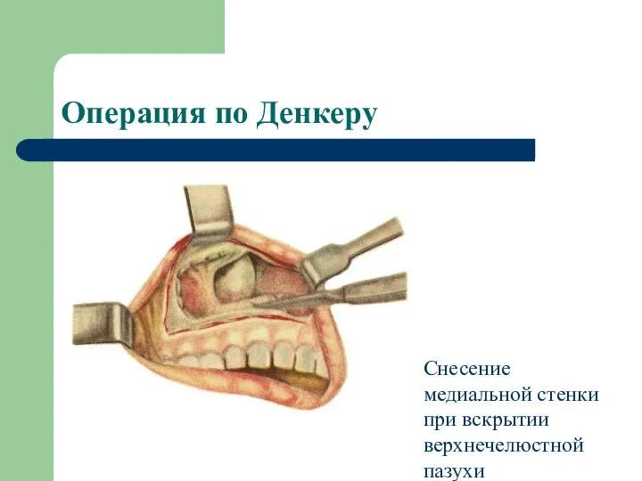 Операция по Денкеру Снесение медиальной стенки при вскрытии верхнечелюстной пазухи