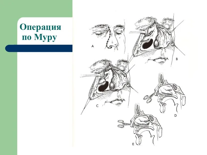 Операция по Муру