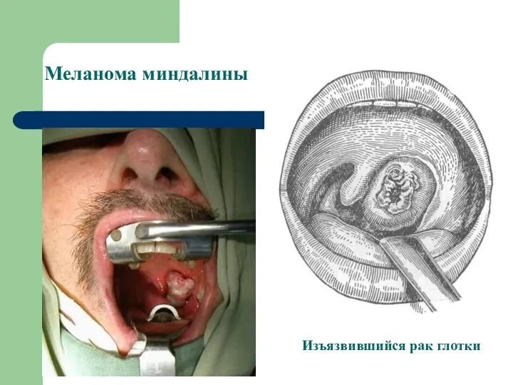 Меланома миндалины Изъязвившийся рак глотки