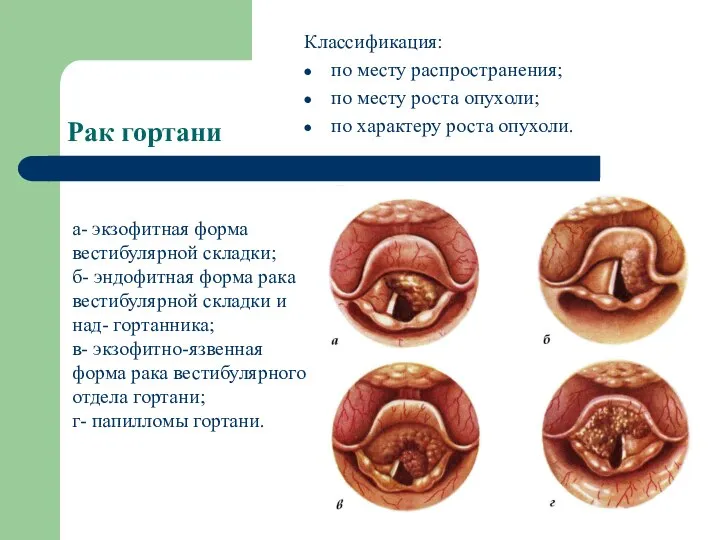 Рак гортани Классификация: по месту распространения; по месту роста опухоли; по