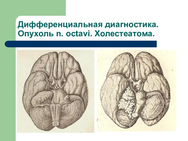 Дифференциальная диагностика. Опухоль n. octavi. Холестеатома.