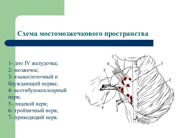 Схема мостомозжечкового пространства 1- дно IV желудочка; 2- мозжечок; 3- языкоглоточный