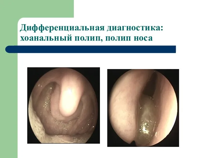 Дифференциальная диагностика: хоанальный полип, полип носа