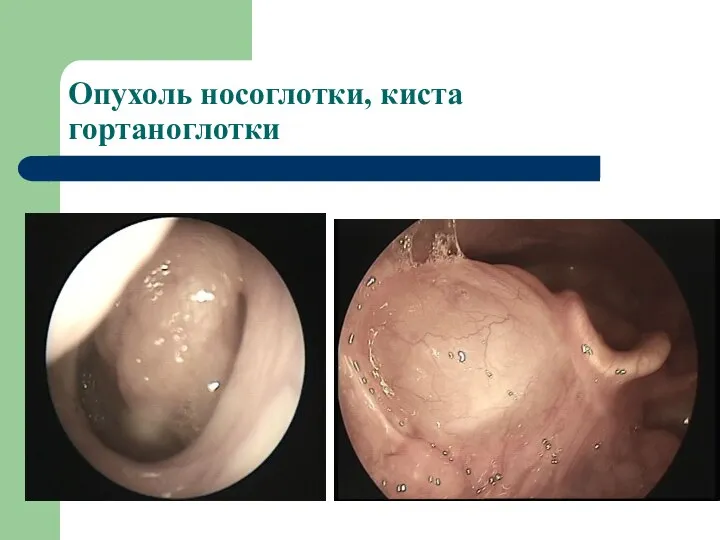 Опухоль носоглотки, киста гортаноглотки