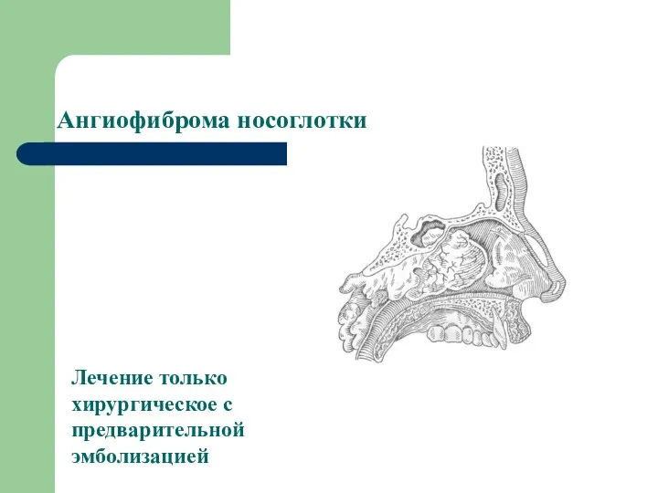 Ангиофиброма носоглотки Лечение только хирургическое с предварительной эмболизацией