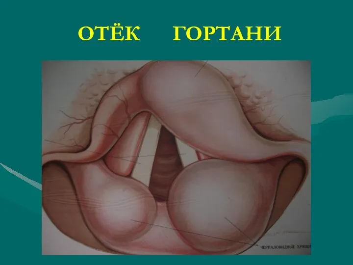 ОТЁК ГОРТАНИ