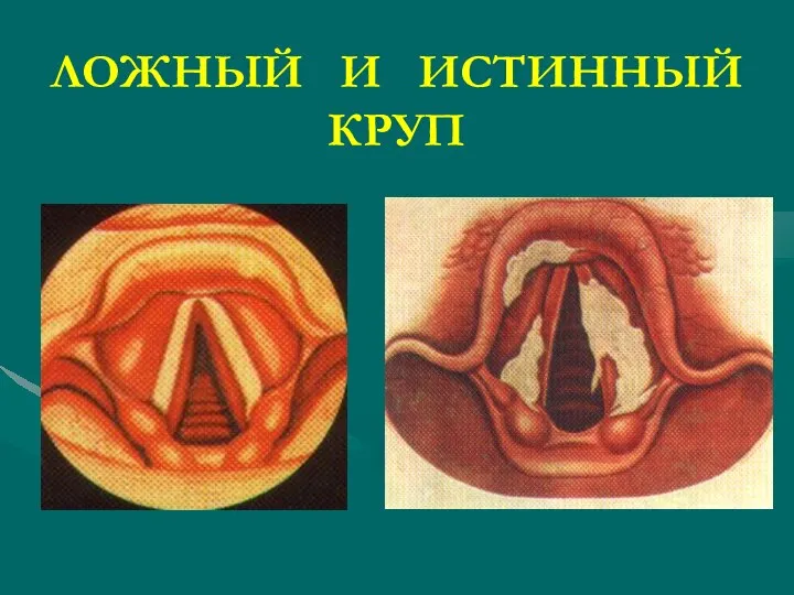 ЛОЖНЫЙ И ИСТИННЫЙ КРУП