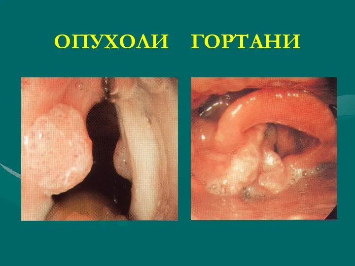 ОПУХОЛИ ГОРТАНИ