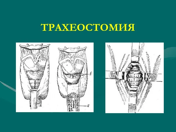 ТРАХЕОСТОМИЯ