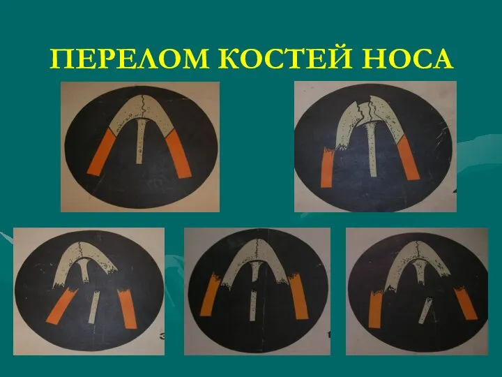 ПЕРЕЛОМ КОСТЕЙ НОСА