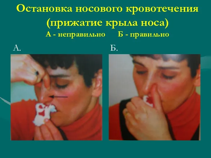 Остановка носового кровотечения (прижатие крыла носа) А - неправильно Б - правильно А. Б.