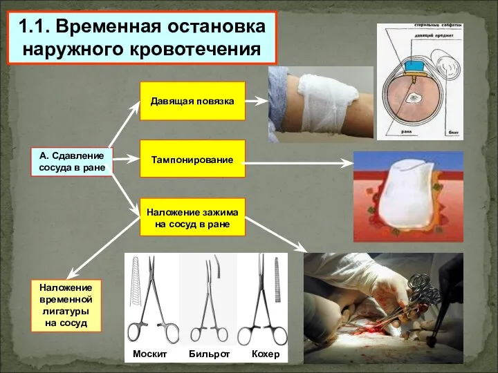 1.1. Временная остановка наружного кровотечения А. Сдавление сосуда в ране Давящая