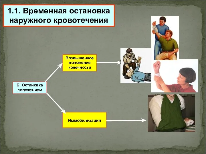 1.1. Временная остановка наружного кровотечения Б. Остановка положением Возвышенное положение конечности Иммобилизация