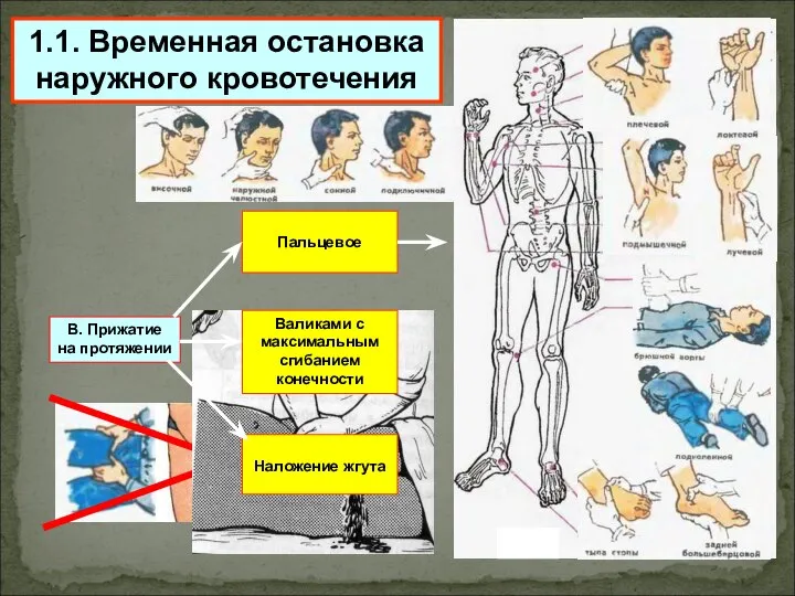 1.1. Временная остановка наружного кровотечения В. Прижатие на протяжении Пальцевое Валиками