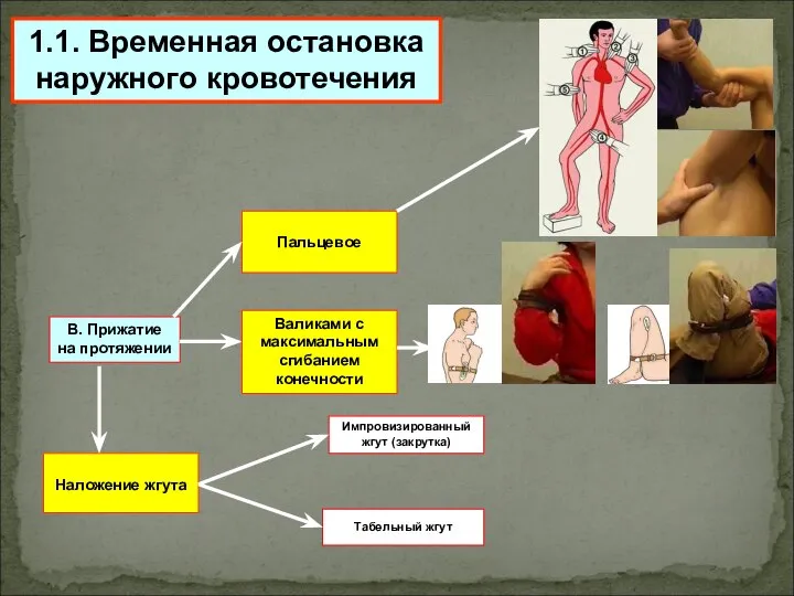 1.1. Временная остановка наружного кровотечения В. Прижатие на протяжении Пальцевое Наложение