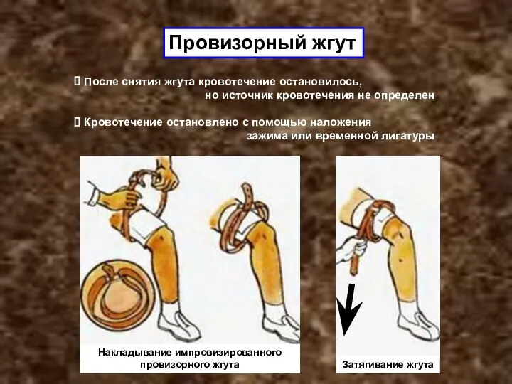 Провизорный жгут После снятия жгута кровотечение остановилось, но источник кровотечения не