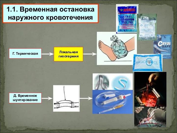 1.1. Временная остановка наружного кровотечения Г. Термическая Локальная гипотермия Д. Временное шунтирование