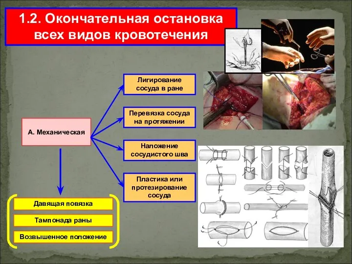 1.2. Окончательная остановка всех видов кровотечения А. Механическая Лигирование сосуда в