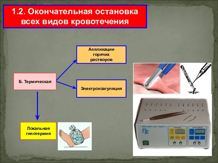 1.2. Окончательная остановка всех видов кровотечения Б. Термическая Локальная гипотермия Аппликации горячих растворов Электрокоагуляция