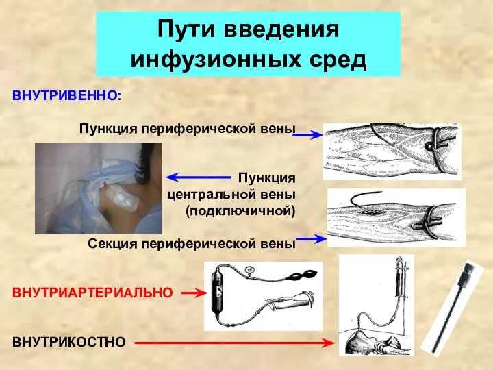 ВНУТРИВЕННО: Пункция периферической вены Пункция центральной вены (подключичной) Секция периферической вены