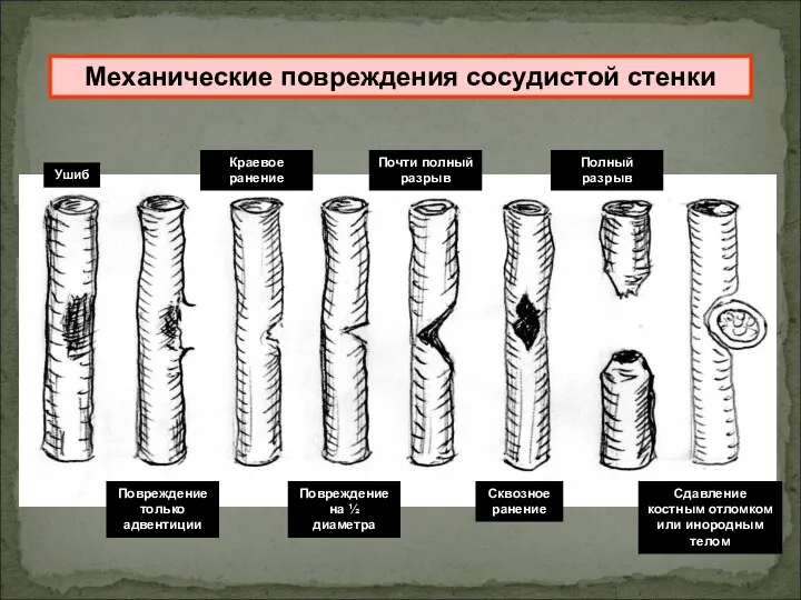 Механические повреждения сосудистой стенки Ушиб Повреждение только адвентиции Краевое ранение Повреждение