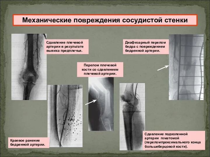 Сдавление плечевой артерии в результате вывиха предплечья. Сдавление подколенной артерии гематомой