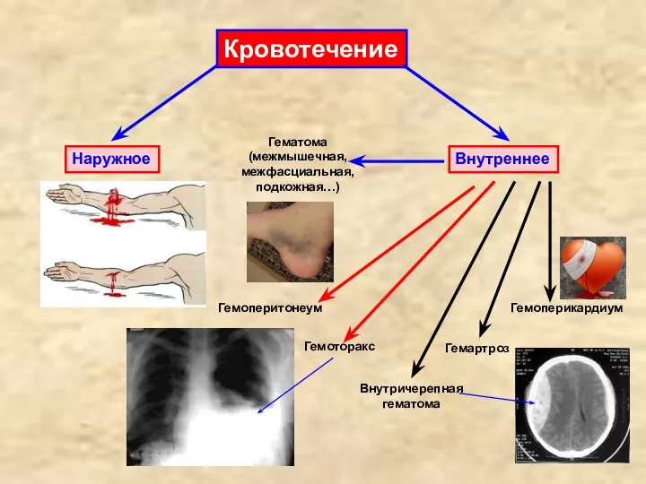 Кровотечение Внутреннее Наружное Гематома (межмышечная, межфасциальная, подкожная…) Гемоперитонеум Гемоторакс Гемоперикардиум Гемартроз Внутричерепная гематома