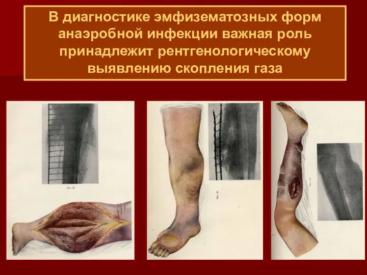 В диагностике эмфизематозных форм анаэробной инфекции важная роль принадлежит рентгенологическому выявлению скопления газа