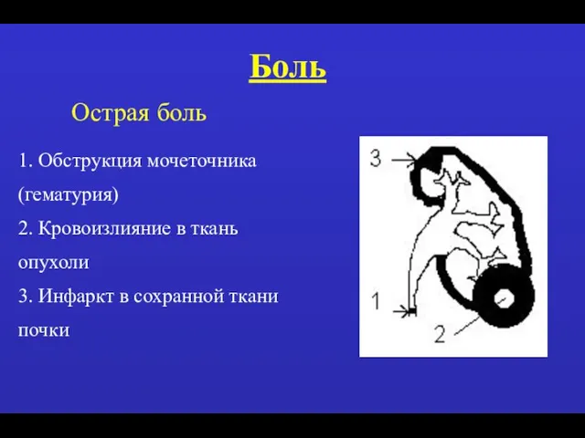 Боль Острая боль 1. Обструкция мочеточника (гематурия) 2. Кровоизлияние в ткань