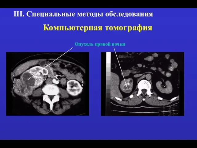 III. Специальные методы обследования Компьютерная томография Опухоль правой почки