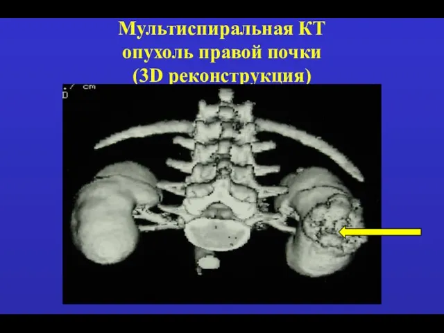 Мультиспиральная КТ опухоль правой почки (3D реконструкция)