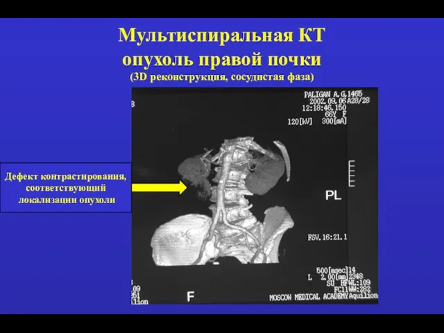 Мультиспиральная КТ опухоль правой почки (3D реконструкция, сосудистая фаза) Дефект контрастирования, соответствующий локализации опухоли