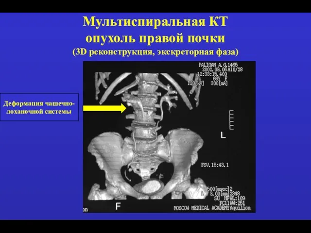 Мультиспиральная КТ опухоль правой почки (3D реконструкция, экскреторная фаза) Деформация чашечно- лоханочной системы