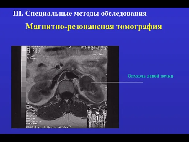 III. Специальные методы обследования Магнитно-резонансная томография Опухоль левой почки