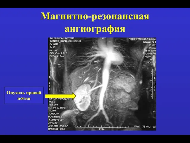 Магнитно-резонансная ангиография Опухоль правой почки