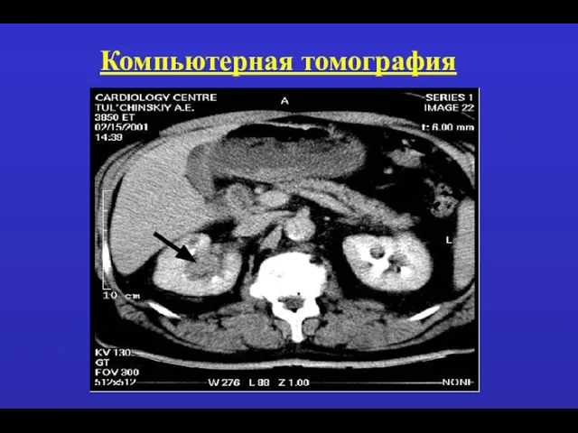 Компьютерная томография