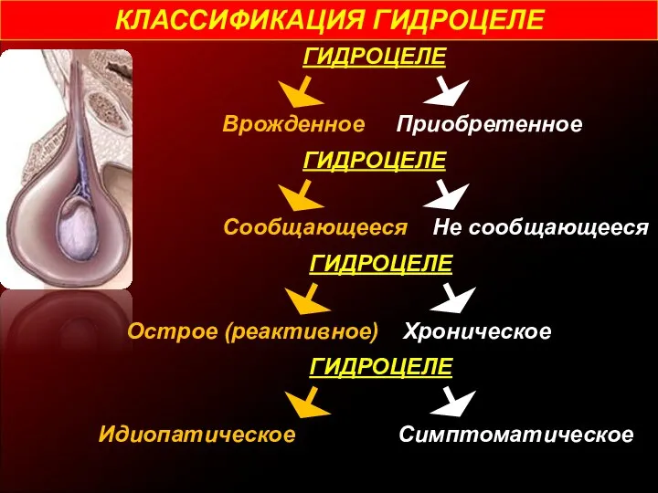 КЛАССИФИКАЦИЯ ГИДРОЦЕЛЕ ГИДРОЦЕЛЕ Врожденное Приобретенное ГИДРОЦЕЛЕ Сообщающееся Не сообщающееся ГИДРОЦЕЛЕ Острое (реактивное) Хроническое ГИДРОЦЕЛЕ Идиопатическое Симптоматическое