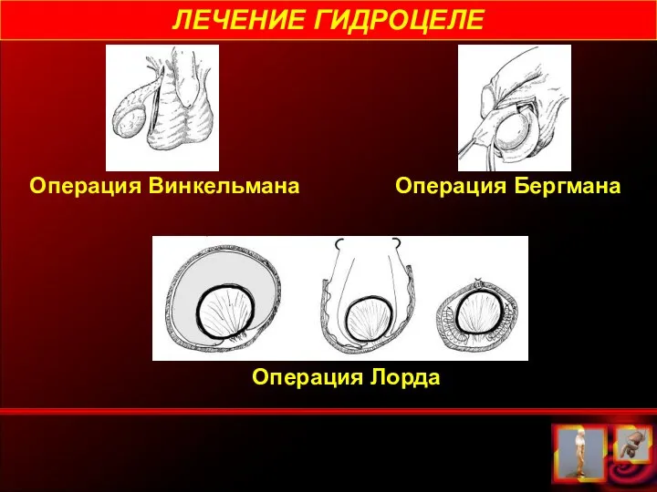 ЛЕЧЕНИЕ ГИДРОЦЕЛЕ Операция Винкельмана Операция Бергмана Операция Лорда