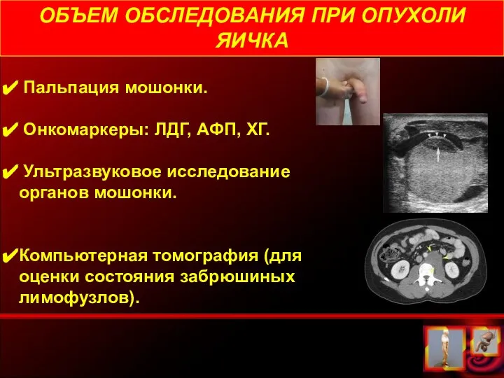 ОБЪЕМ ОБСЛЕДОВАНИЯ ПРИ ОПУХОЛИ ЯИЧКА Пальпация мошонки. Онкомаркеры: ЛДГ, АФП, ХГ.