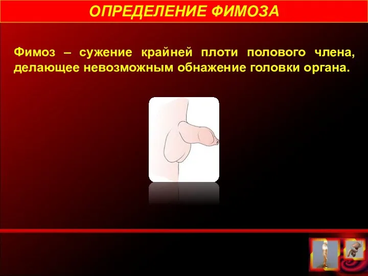 ОПРЕДЕЛЕНИЕ ФИМОЗА Фимоз – сужение крайней плоти полового члена, делающее невозможным обнажение головки органа.