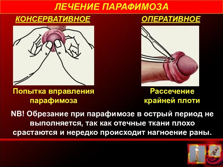 ЛЕЧЕНИЕ ПАРАФИМОЗА КОНСЕРВАТИВНОЕ ОПЕРАТИВНОЕ Попытка вправления парафимоза Рассечение крайней плоти NB!