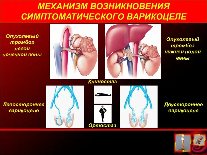 МЕХАНИЗМ ВОЗНИКНОВЕНИЯ СИМПТОМАТИЧЕСКОГО ВАРИКОЦЕЛЕ Опухолевый тромбоз левой почечной вены Опухолевый тромбоз