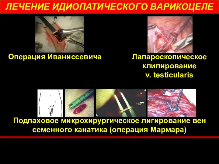 ЛЕЧЕНИЕ ИДИОПАТИЧЕСКОГО ВАРИКОЦЕЛЕ Операция Иваниссевича Лапароскопическое клипирование v. testicularis Подпаховое микрохирургическое