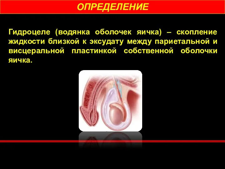 ОПРЕДЕЛЕНИЕ Гидроцеле (водянка оболочек яичка) – скопление жидкости близкой к эксудату