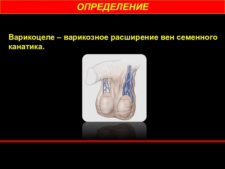 ОПРЕДЕЛЕНИЕ Варикоцеле – варикозное расширение вен семенного канатика.