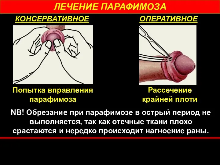 ЛЕЧЕНИЕ ПАРАФИМОЗА КОНСЕРВАТИВНОЕ ОПЕРАТИВНОЕ Попытка вправления парафимоза Рассечение крайней плоти NB!