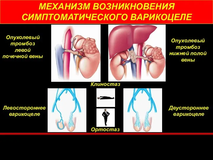 МЕХАНИЗМ ВОЗНИКНОВЕНИЯ СИМПТОМАТИЧЕСКОГО ВАРИКОЦЕЛЕ Опухолевый тромбоз левой почечной вены Опухолевый тромбоз